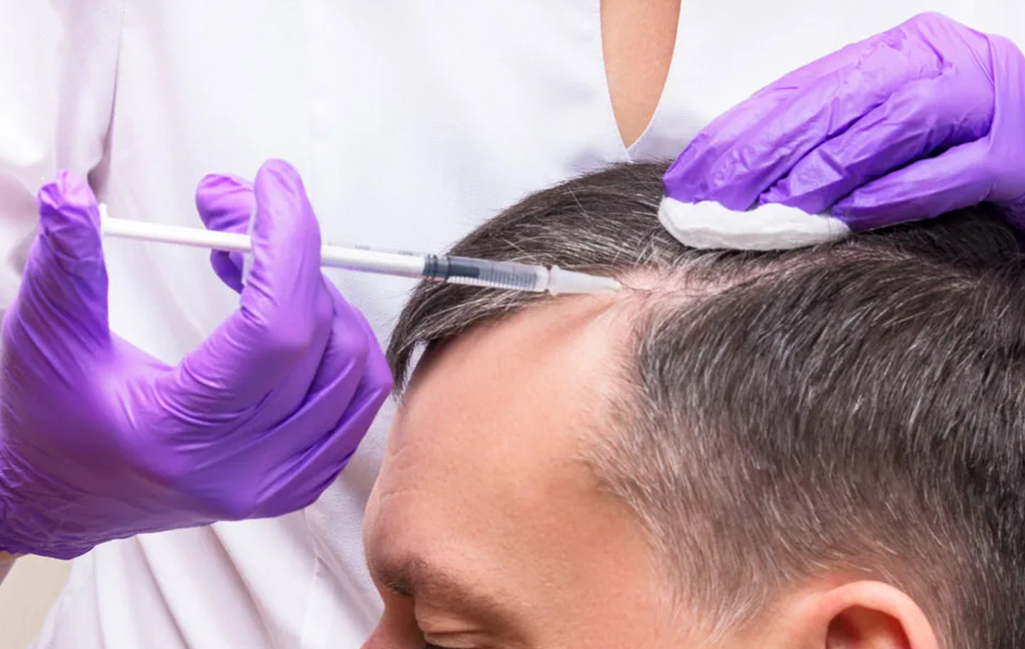 PRP Hair Restoration